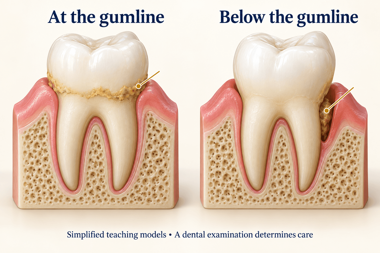 Simplified tooth cutaways showing deposits at and below the gumline.