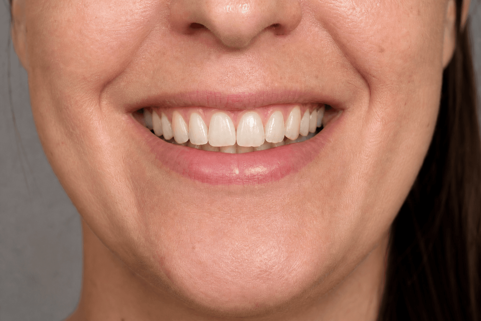 Smile treatment comparison